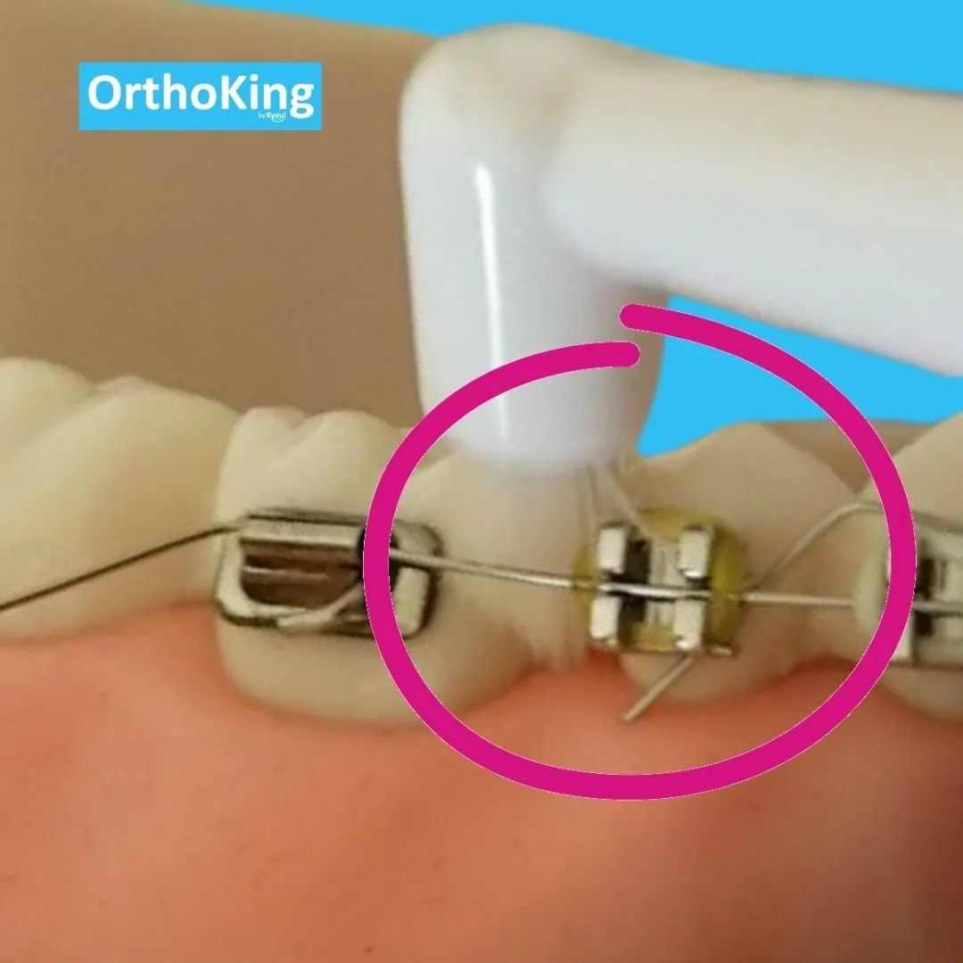 Orthoking Portable Plaque Remover